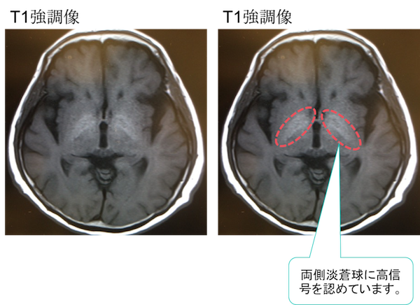 肝性脳症・肝硬変の頭部MRIの画像診断は？T1WIで高信号？